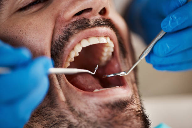 Best Emergency Wisdom Teeth Removal in Goose Creek, SC